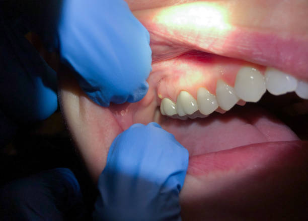 Best Emergency Treatment for Dental Infections or Abscesses in Winthrop Harbor, IL